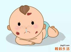 孩子有胎记好吗