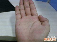 手掌长痣代表什么