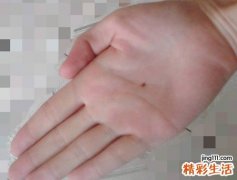 掌心痣代表什么意思