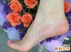 脚底长痣代表什么