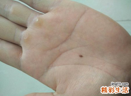 掌心痣代表财运旺盛吗