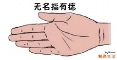 无名指有痣的女人命运 无名指长痣代表什么