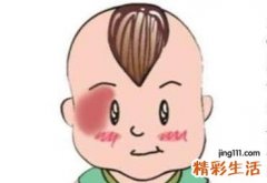 脸上有胎记的人命好吗 脸上有胎记命运