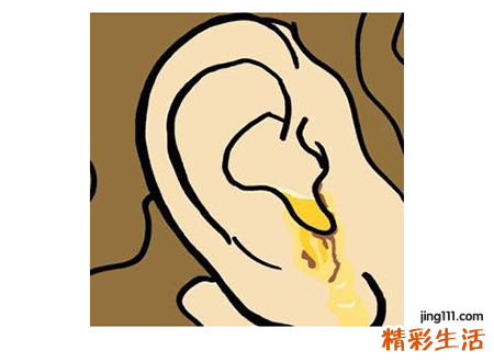 梦见耳屎代表什么,做梦梦到老婆的左耳掏出特大块耳屎