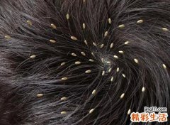 梦见把头上虱子弄下来，做梦梦见头上长虱子是什么意思