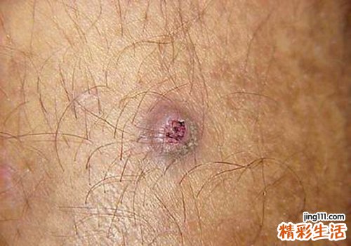 痤疮有什么症状