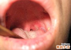 扁桃体发炎反复发烧是什么原因 有没有必要切除扁桃体