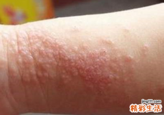 得了湿疹可以吃韭菜吗 韭菜汁外擦治疗湿疹