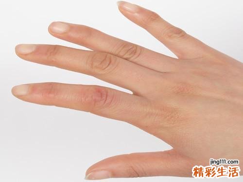 手上冻疮怎么治疗最好 怎么预防冻疮