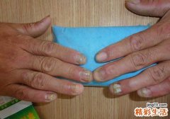 灰指甲会传染别人吗