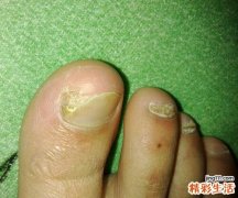 脚趾甲变厚发黄怎么回事