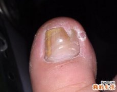 脚趾甲白色怎么回事 脚趾甲里面空了有白色粉末是怎么回事