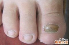 灰指甲擦什么药好