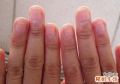 灰指甲反复发作折磨人怎么办 看完这些让你告别痛苦