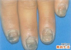 有灰指甲的人穿了我的鞋我还能穿吗 看完这些你就明白了