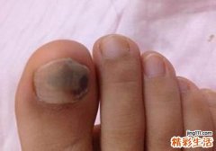 灰指甲可以做美甲吗 有灰指甲的美甲师会传染吗