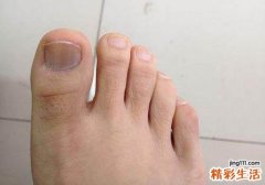 灰指甲里面是空的吗 指甲空的是灰指甲的前兆吗