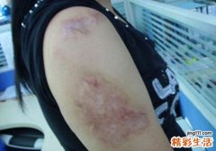 烫伤的疤能去掉吗