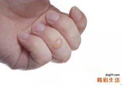手指被烫伤了非常疼怎么办