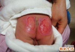 婴儿屁股烫伤怎么办
