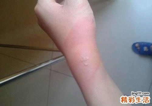 暖宝宝轻微烫伤怎么办 用暖宝宝烫伤后的注意事项