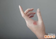 烫伤后怎么处理 一分钟教你快速急救