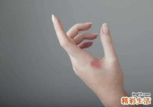 烫伤后怎么处理 一分钟教你快速急救