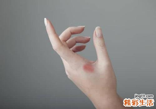 夏天烫伤要包扎吗 夏天烫伤怎么处理