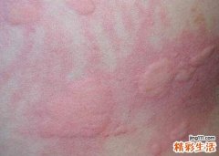 秋季荨麻疹会不会传染