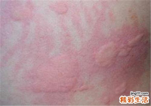 荨麻疹分为几种类型