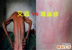 荨麻疹和艾滋病有关系吗