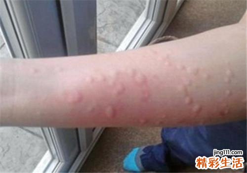 荨麻疹可以根治吗