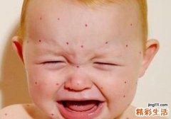 为啥宝宝身上莫名起红包？宝宝荨麻疹怎么办？