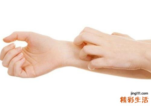 荨麻疹有哪些症状表现 荨麻疹的饮食禁忌