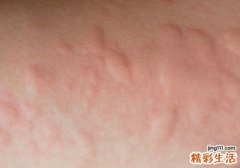 荨麻疹会不会传染 带你详细了解荨麻疹