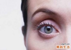 下眼袋水肿是什么原因 下眼袋水肿怎么办
