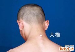 发烧搓哪个部位退烧快 推拿、穴位按摩快速退烧