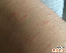 被蚊子咬了起红点怎么回事