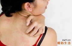 生完孩子身上痒是怎么回事 产后身上痒怎么办