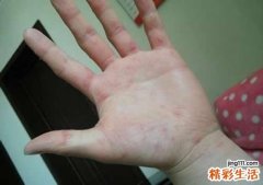 手心痒有红点是怎么回事