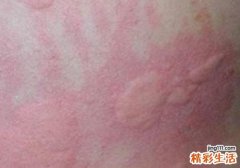 风疹和荨麻疹的区别