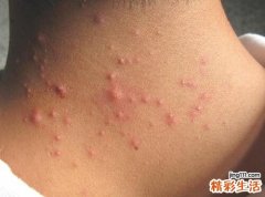 毛囊炎多久才能好