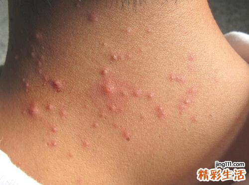 毛囊炎多久才能好
