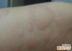 风疹会不会传染人