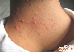 毛囊炎可以用红霉素软膏吗