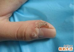 瘊子去掉后还会长吗