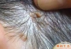 瘊子用头发绑多久会掉