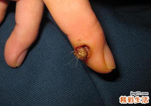 瘊子复发的原因是什么