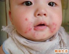 儿童为何易患脓疱疮
