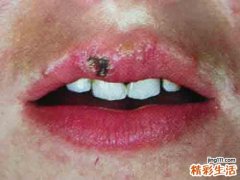 口唇疱疹是什么引起的